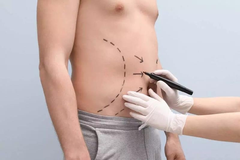 Dr. Octávio Curi Frascareli – Lipoaspiração Masculina: o que muda na técnica e nos resultados